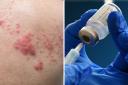 Public Health Scotland said the shingles vaccine reduces the likelihood of getting the virus